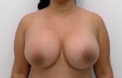 Breast Augmentation Before & After Patient #915