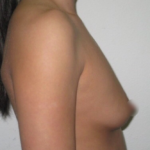 Breast Augmentation Before & After Patient #918