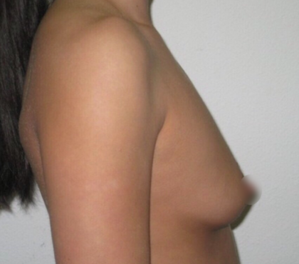 Breast Augmentation Before & After Patient #918