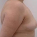 Breast Augmentation Before & After Patient #926