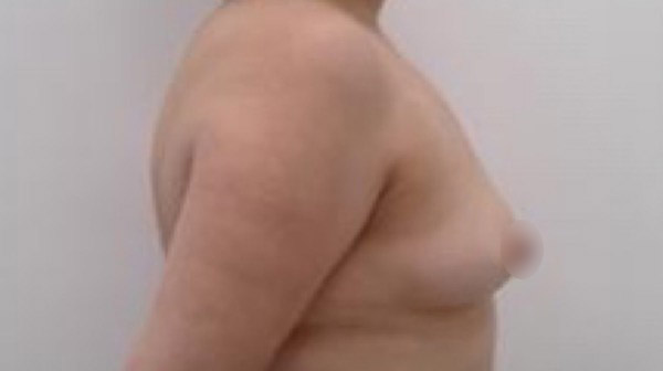 Breast Augmentation Before & After Patient #926