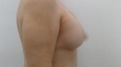 Breast Augmentation Before & After Patient #926