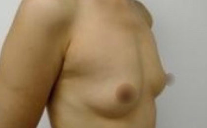 Breast Augmentation Before & After Patient #929