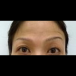 Botox Before & After Patient #1011