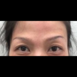 Botox Before & After Patient #1011