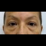 Blepharoplasty Before & After Patient #1014