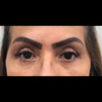 Blepharoplasty Before & After Patient #1014