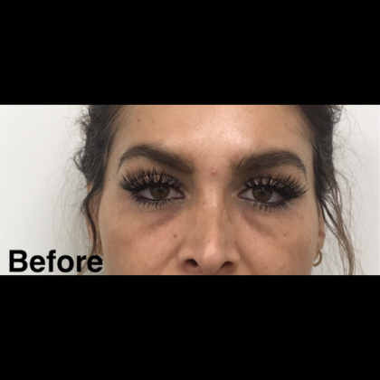 Under Eye Fillers Before & After Patient #1052