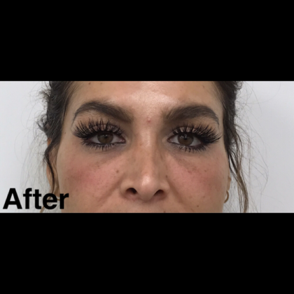 Under Eye Fillers Before & After Patient #1052