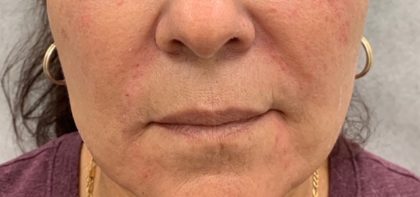 Facial Fillers Before & After Patient #1017