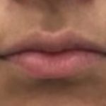 Lip Fillers Before & After Patient #1020