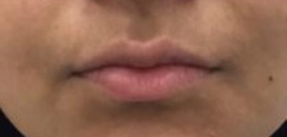 Lip Fillers Before & After Patient #1020