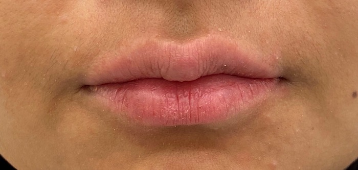 Lip Fillers Before & After Patient #1020