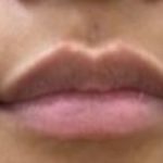 Lip Fillers Before & After Patient #1023