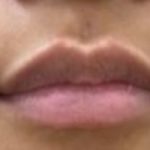 Lip Fillers Before & After Patient #1023
