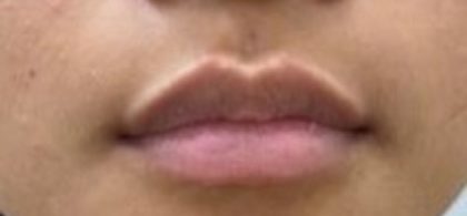 Lip Fillers Before & After Patient #1023