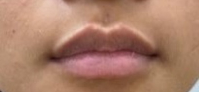 Lip Fillers Before & After Patient #1023