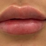 Lip Fillers Before & After Patient #1023