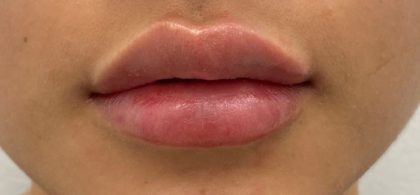 Lip Fillers Before & After Patient #1023