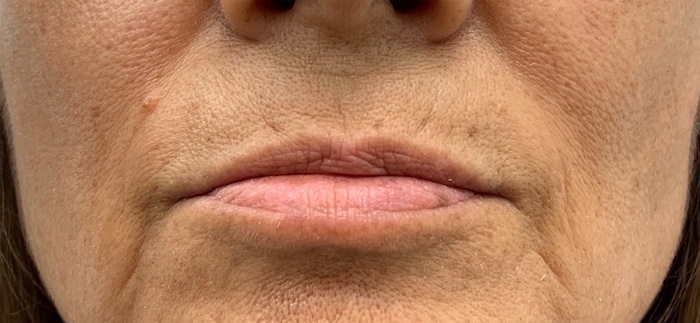 Lip Fillers Before & After Patient #1029