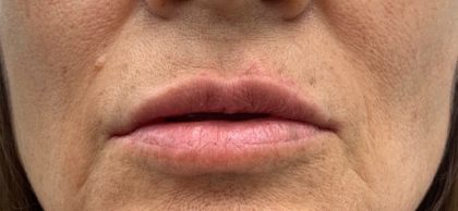 Lip Fillers Before & After Patient #1029