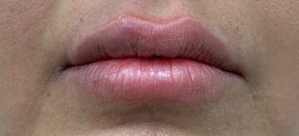 Lip Fillers Before & After Patient #1035