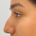 Non-Surgical Rhinoplasty Before & After Patient #1041