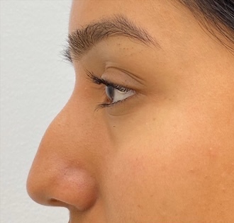 Non-Surgical Rhinoplasty Before & After Patient #1041