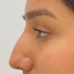 Non-Surgical Rhinoplasty Before & After Patient #1041