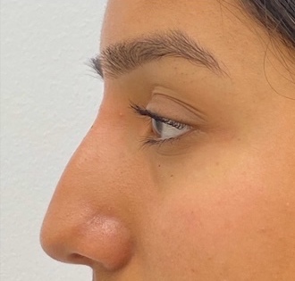 Non-Surgical Rhinoplasty Before & After Patient #1041