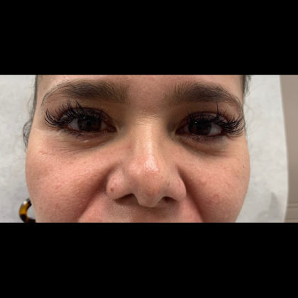 Under Eye Fillers Before & After Patient #1047