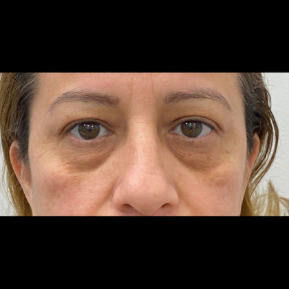 Eye Lift Before & After Patient #1114