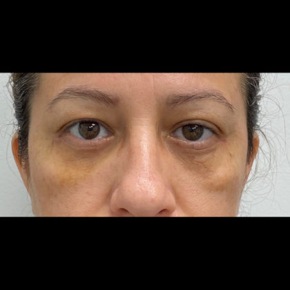 Eye Lift Before & After Patient #1114