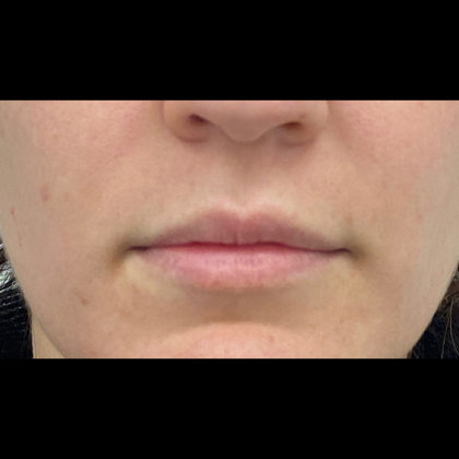 Lip Fillers Before & After Patient #1125