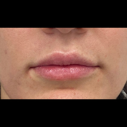 Lip Fillers Before & After Patient #1125