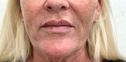 Facial Fillers Before & After Patient #1106