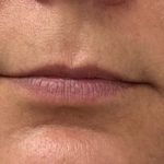 Lip Fillers Before & After Patient #1109