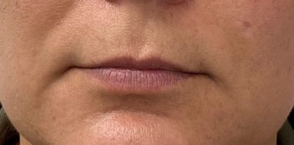 Lip Fillers Before & After Patient #1109