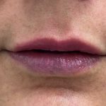 Lip Fillers Before & After Patient #1109