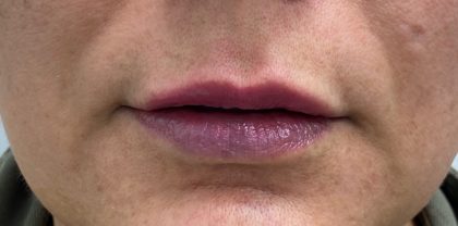 Lip Fillers Before & After Patient #1109