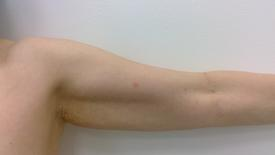 Liposculpture Before & After Patient #1098