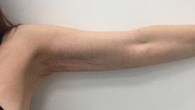 Liposculpture Before & After Patient #1098