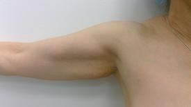 Liposculpture Before & After Patient #1098