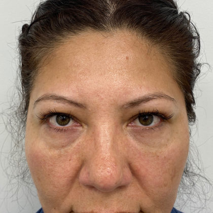 Under Eye Fillers Before & After Patient #1128