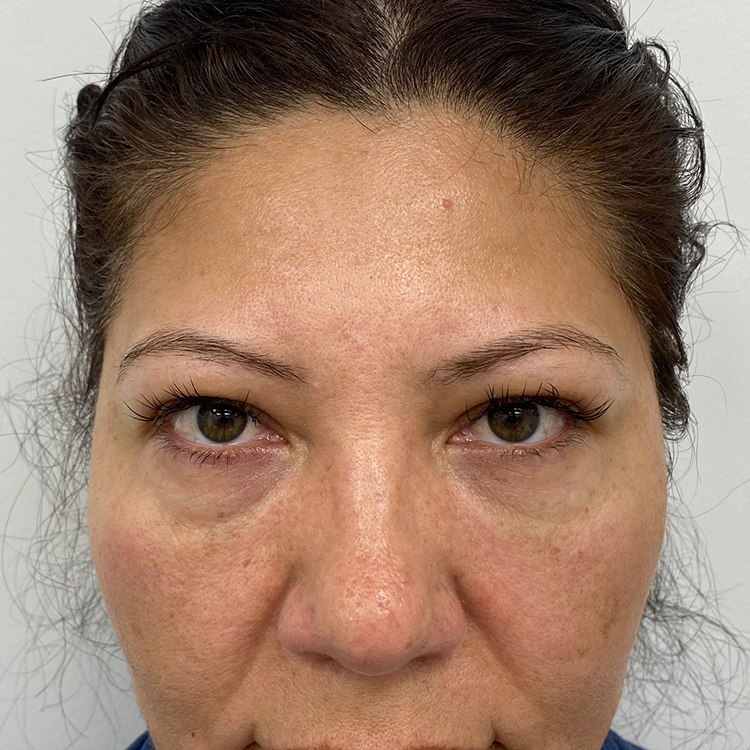 Under Eye Fillers Before & After Patient #1128