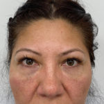 Under Eye Fillers Before & After Patient #1128