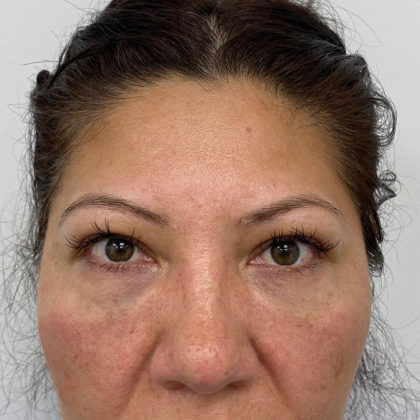 Under Eye Fillers Before & After Patient #1128