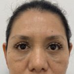 Eye Lift Before & After Patient #1223