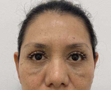 Eye Lift Before & After Patient #1223