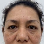 Eye Lift Before & After Patient #1223